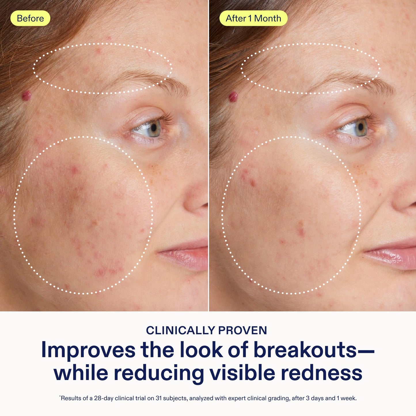 Skinfix 2% BHA Cleanser (5 oz) + Adapinoid Gel (1 oz) - Safe for All Types of Acne - Fragrance Free - Vegan, Cruelty Free