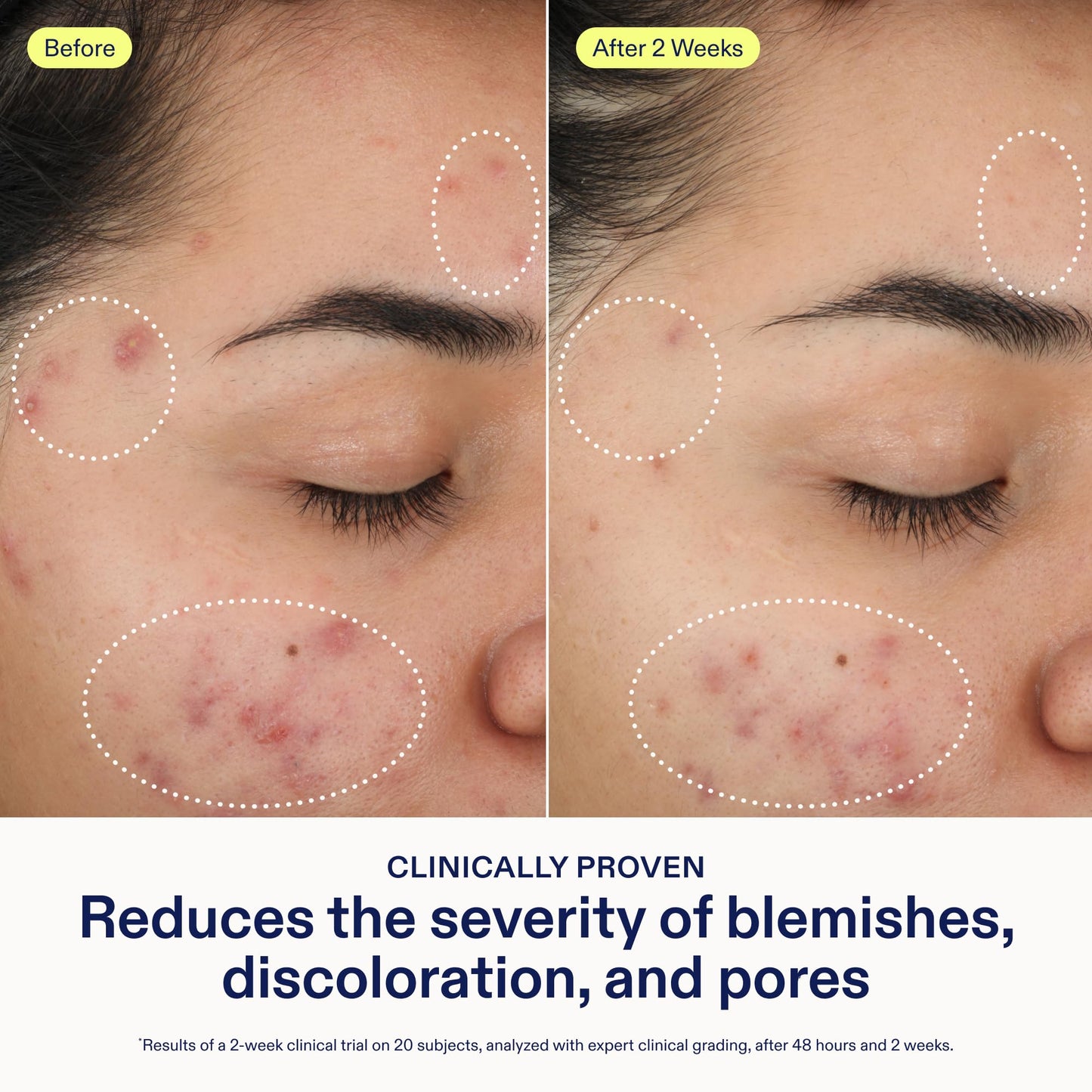 Skinfix 2% BHA Cleanser (5 oz) + Adapinoid Gel (1 oz) - Safe for All Types of Acne - Fragrance Free - Vegan, Cruelty Free